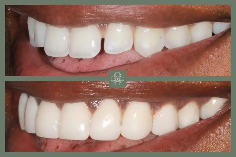 Composite bonding in Hornchurch: what you need to know about this popular dental treatment
