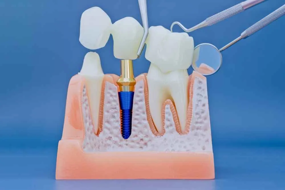 Dental implant supporting a replacement tooth alongside natural teeth