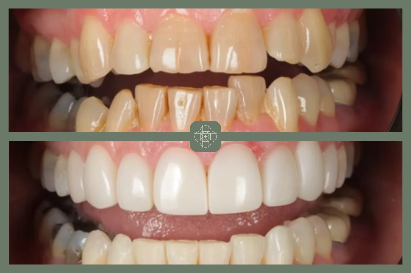 Invisalign in Hornchurch: a patient guide to cosmetic dentistry treatments