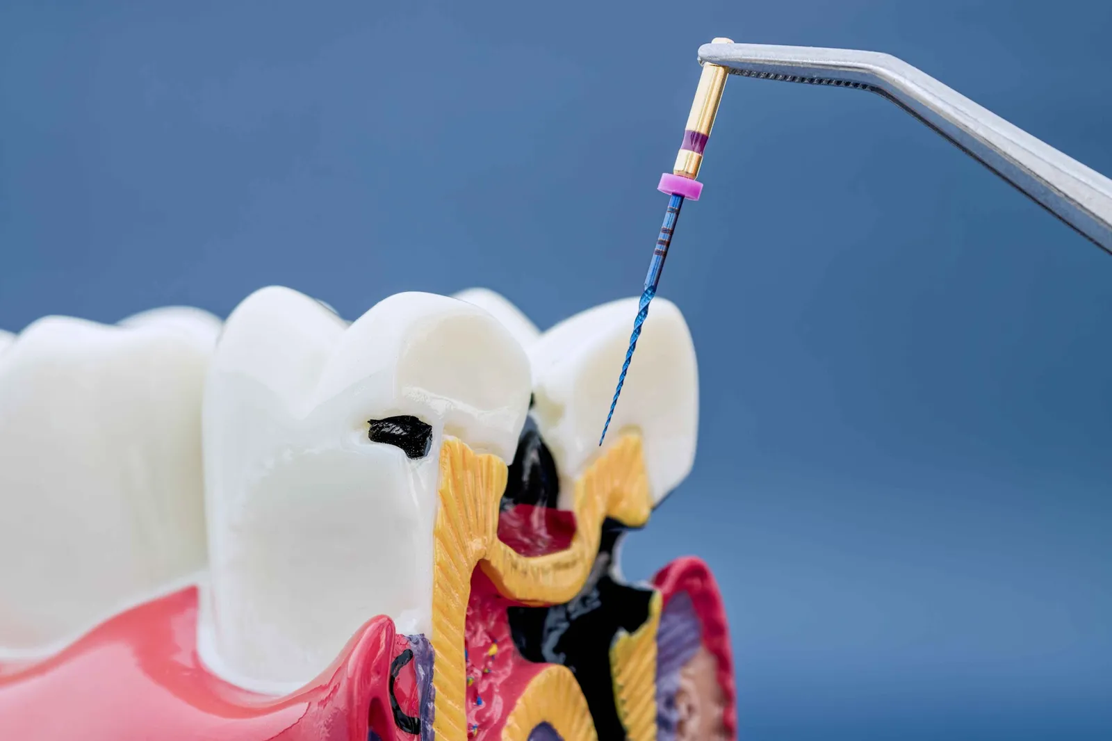 Rotary endodontic instrument used during root canal treatment