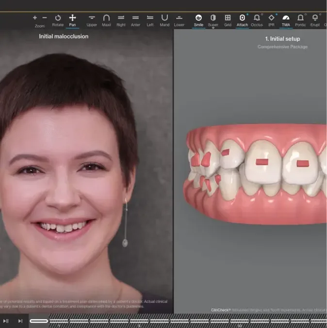ClinCheck digital simulation showing projected Invisalign end result