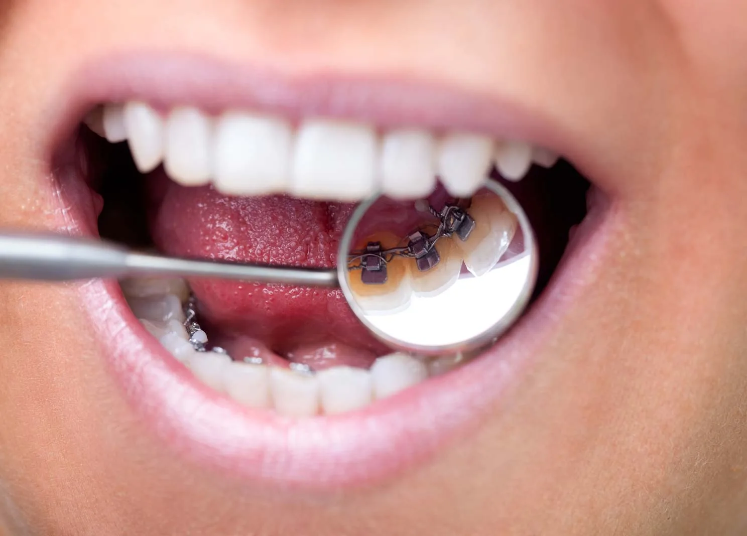 Lingual braces fitted behind the teeth