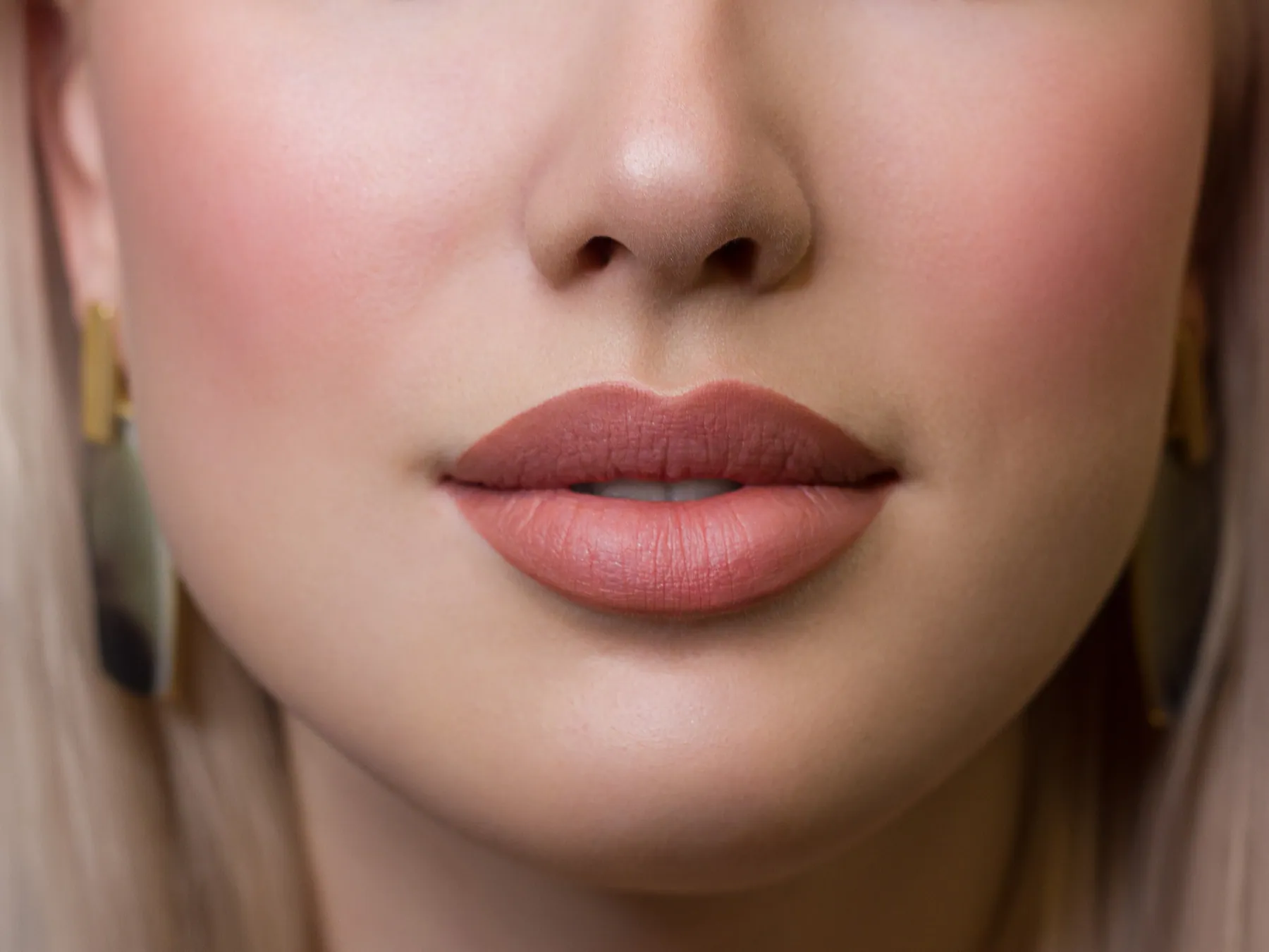 A Hornchurch patient with naturally enhanced lips after lip filler