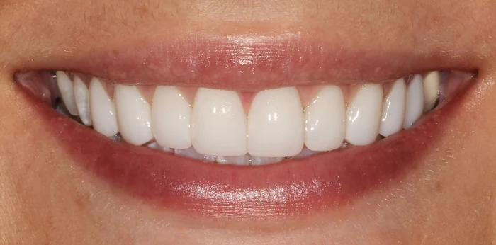 Composite bonding after at Hacton Dental Care