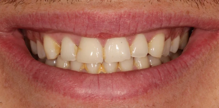 Composite bonding before at Hacton Dental Care