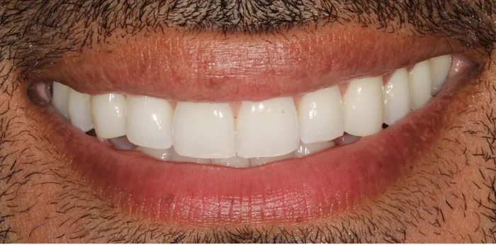 Before composite bonding treatment at Hacton Dental Care, Hornchurch