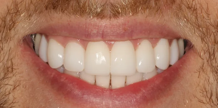 After composite bonding treatment at Hacton Dental Care, Hornchurch