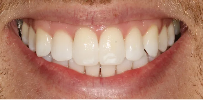 Before composite bonding treatment at Hacton Dental Care, Hornchurch