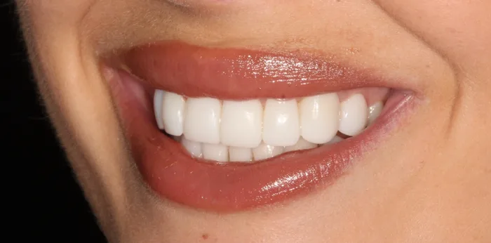 After composite bonding treatment at Hacton Dental Care, Hornchurch