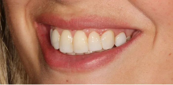 Before composite bonding treatment at Hacton Dental Care, Hornchurch