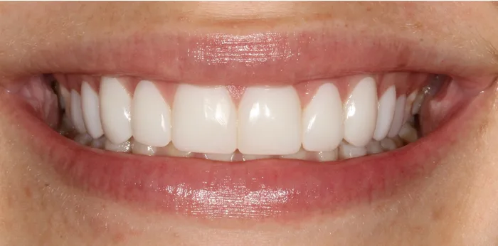 After composite bonding treatment at Hacton Dental Care, Hornchurch