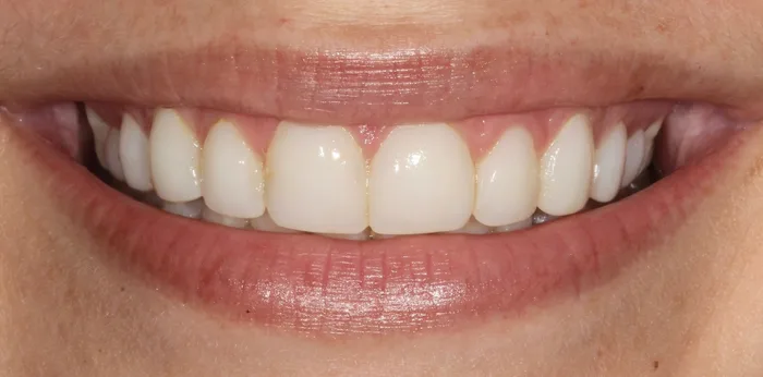 Before composite bonding treatment at Hacton Dental Care, Hornchurch