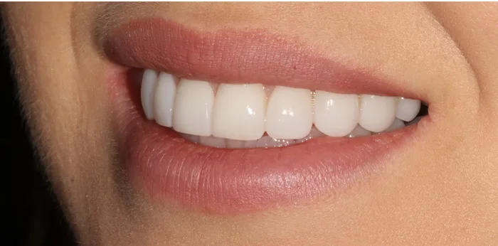 After composite bonding treatment at Hacton Dental Care, Hornchurch