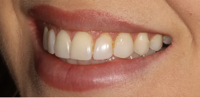 Before composite bonding treatment at Hacton Dental Care, Hornchurch