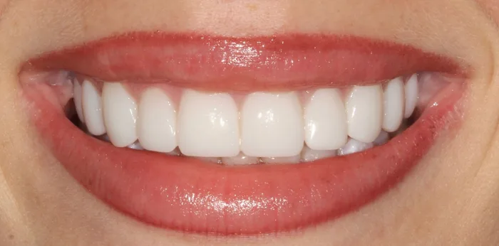 After composite bonding treatment at Hacton Dental Care, Hornchurch