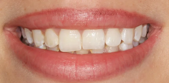 Before composite bonding treatment at Hacton Dental Care, Hornchurch