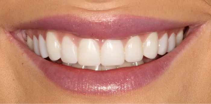 After composite bonding treatment at Hacton Dental Care, Hornchurch