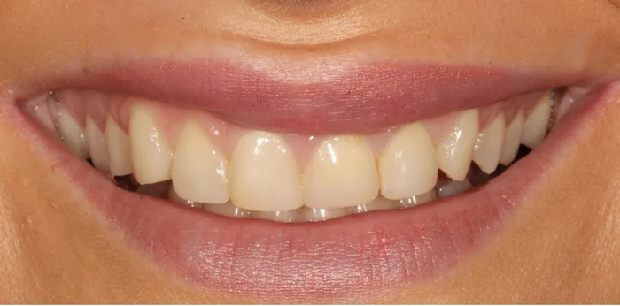 Before composite bonding treatment at Hacton Dental Care, Hornchurch