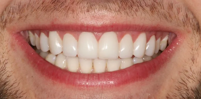 After composite bonding treatment at Hacton Dental Care, Hornchurch