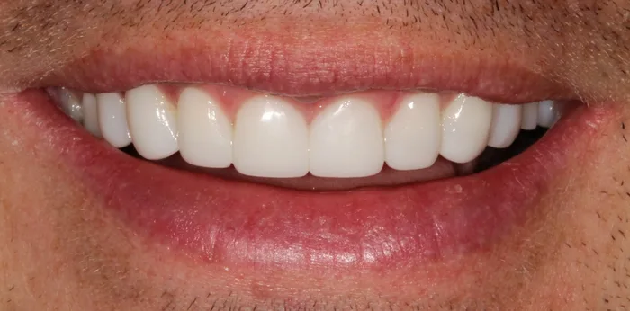 After composite bonding treatment at Hacton Dental Care, Hornchurch
