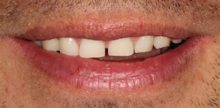 Before composite bonding treatment at Hacton Dental Care, Hornchurch