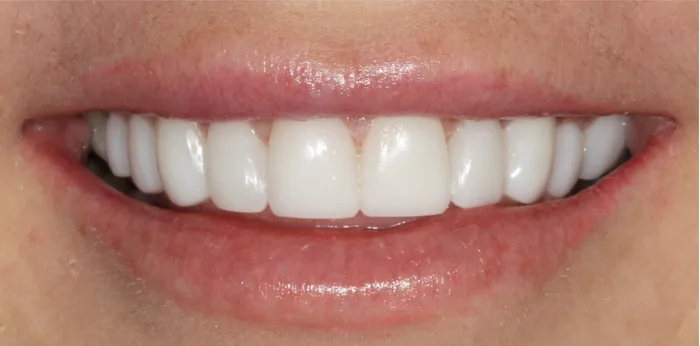 After composite bonding treatment at Hacton Dental Care, Hornchurch