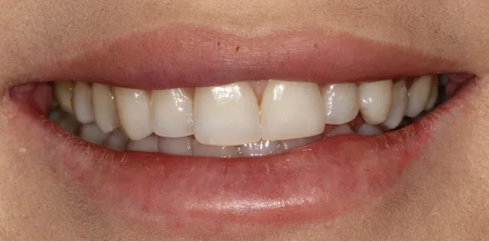 Before composite bonding treatment at Hacton Dental Care, Hornchurch