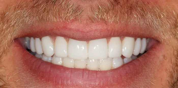 After composite bonding treatment at Hacton Dental Care, Hornchurch