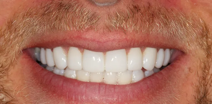 After composite bonding treatment at Hacton Dental Care, Hornchurch