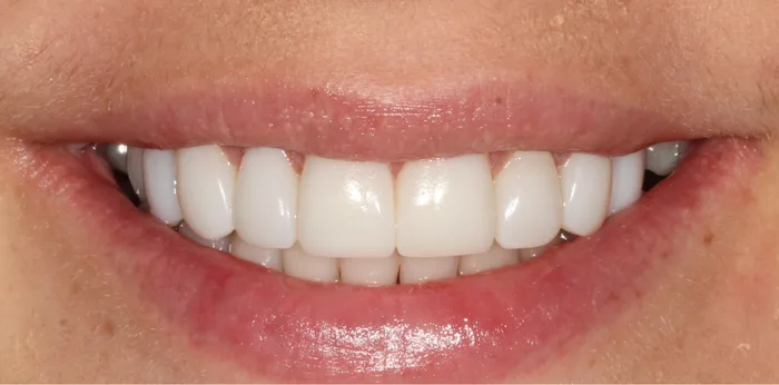 After composite bonding treatment at Hacton Dental Care, Hornchurch