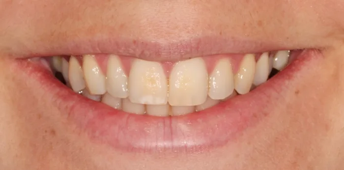 Before composite bonding treatment at Hacton Dental Care, Hornchurch