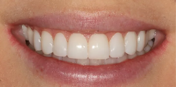 After composite bonding treatment at Hacton Dental Care, Hornchurch