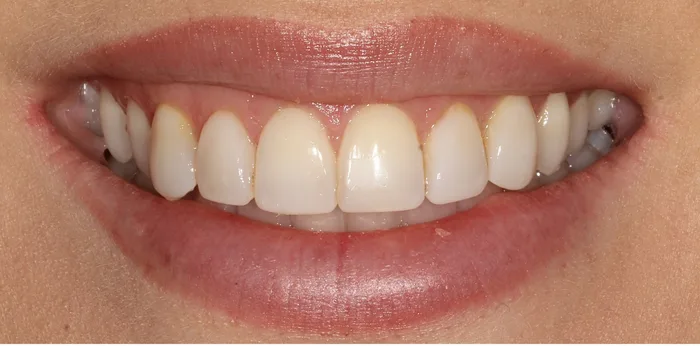 Before composite bonding treatment at Hacton Dental Care, Hornchurch