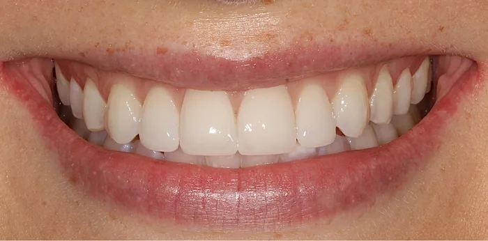 After composite bonding treatment at Hacton Dental Care, Hornchurch