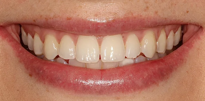 Before composite bonding treatment at Hacton Dental Care, Hornchurch