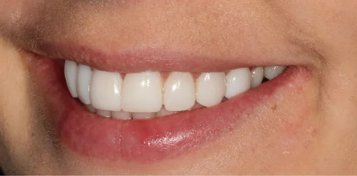 After composite bonding treatment at Hacton Dental Care, Hornchurch