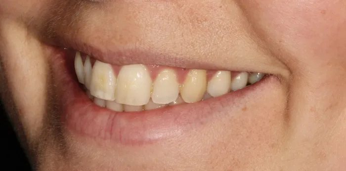 Before composite bonding treatment at Hacton Dental Care, Hornchurch