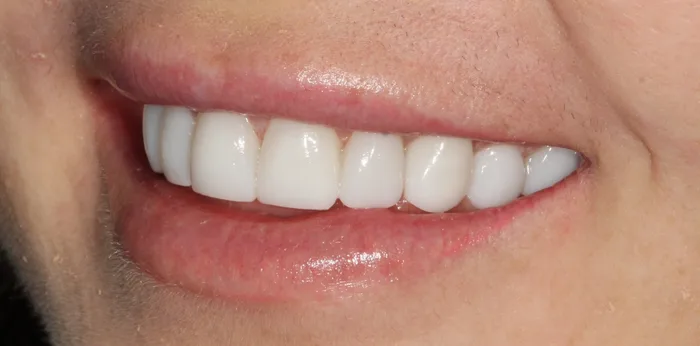 After composite bonding treatment at Hacton Dental Care, Hornchurch