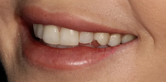 Before composite bonding treatment at Hacton Dental Care, Hornchurch
