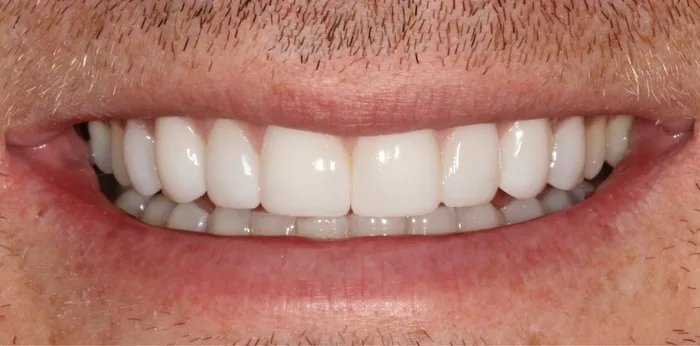 After composite bonding treatment at Hacton Dental Care, Hornchurch