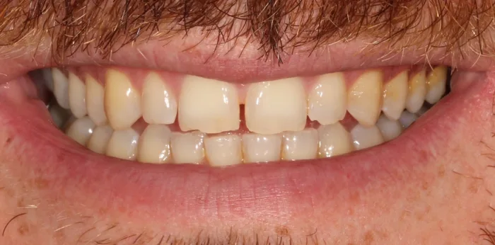 Before composite bonding treatment at Hacton Dental Care, Hornchurch