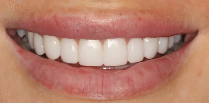 After composite bonding treatment at Hacton Dental Care, Hornchurch