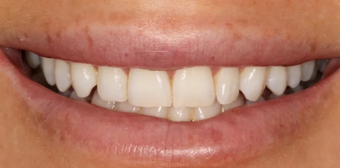 Before composite bonding treatment at Hacton Dental Care, Hornchurch