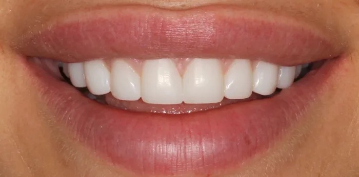 After composite bonding treatment at Hacton Dental Care, Hornchurch
