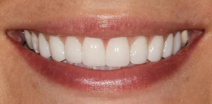 After composite bonding treatment at Hacton Dental Care, Hornchurch