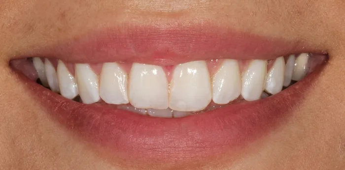 Before composite bonding treatment at Hacton Dental Care, Hornchurch
