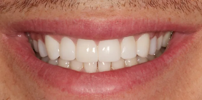 After composite bonding treatment at Hacton Dental Care, Hornchurch