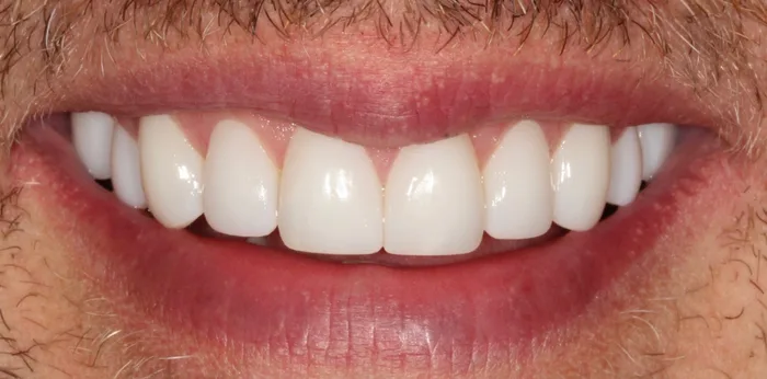 After composite bonding treatment at Hacton Dental Care, Hornchurch