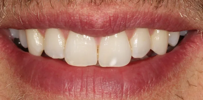 Before composite bonding treatment at Hacton Dental Care, Hornchurch