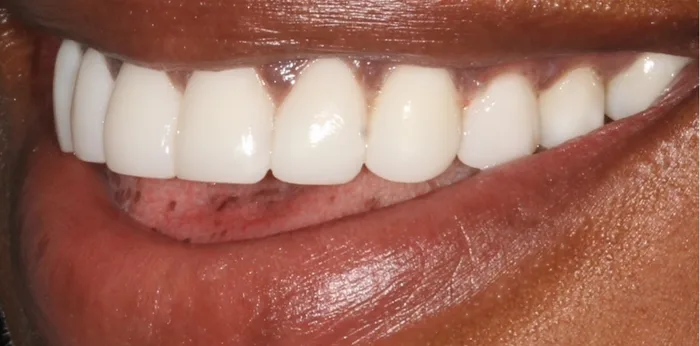 After composite bonding treatment at Hacton Dental Care, Hornchurch